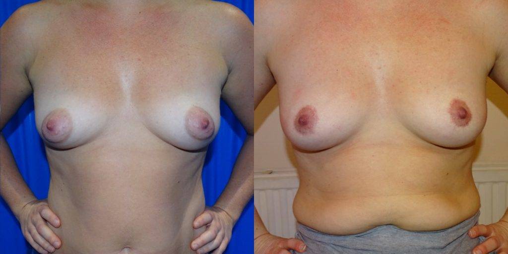 Areola Reduction Before and Afters