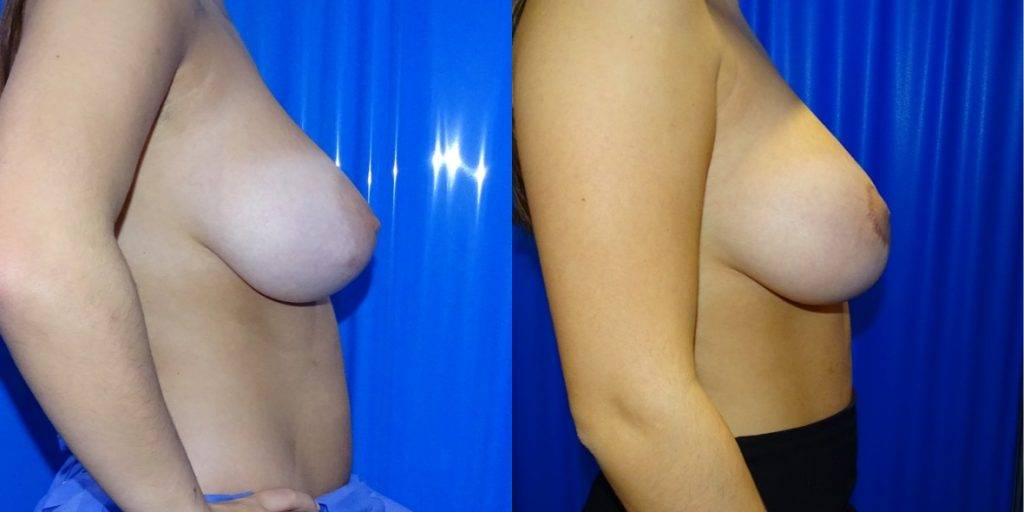 Areola Reduction Before and Afters