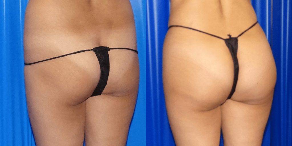 Brazilian Butt Lift Before/ After