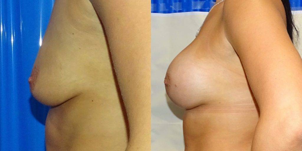 A before and after image of breast implant surgery.