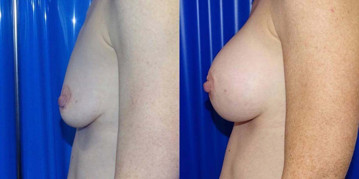 Fat Transfer Vs Breast Implants