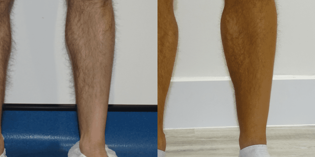 The before and after of a calf augmentation.