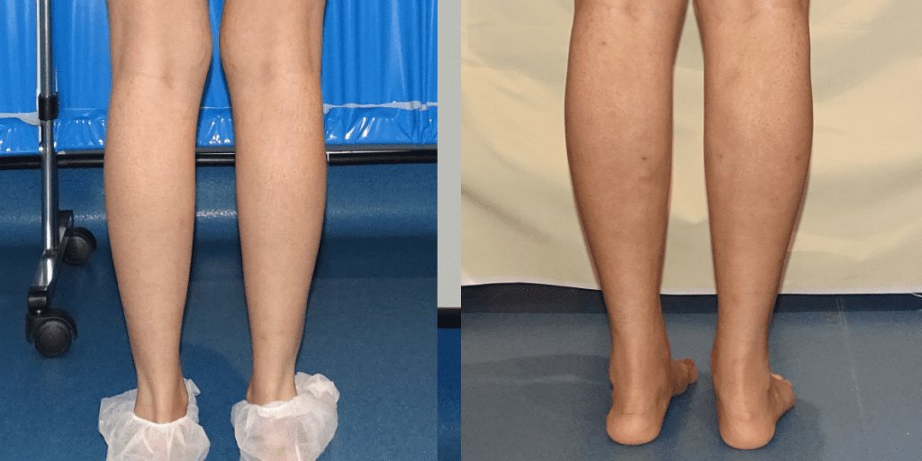 Before and after of a woman's calf augmentation from behind.