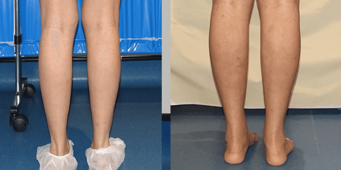 How Much Do Calf Implants Cost in the UK? CREO