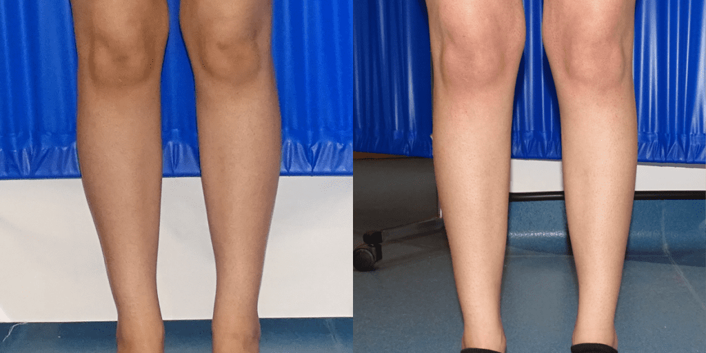 Before and after of a woman's calf augmentation from the front.