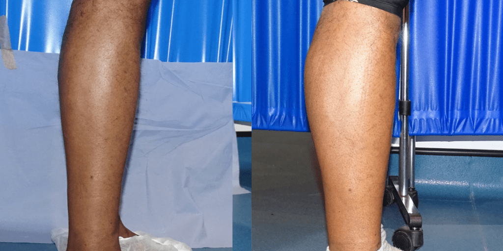 How a calf augmentation looks from the side for darker skin tones.