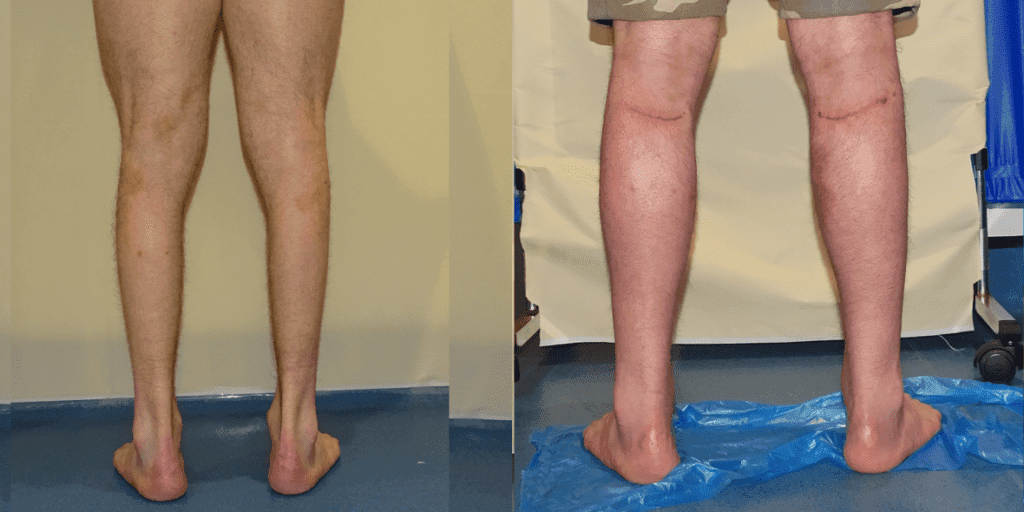 Calf Augmentation London