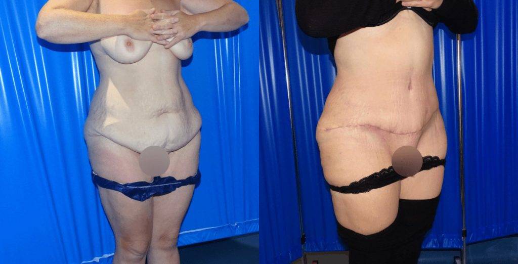 A side view of extended abdominoplasty with some visible scarring.