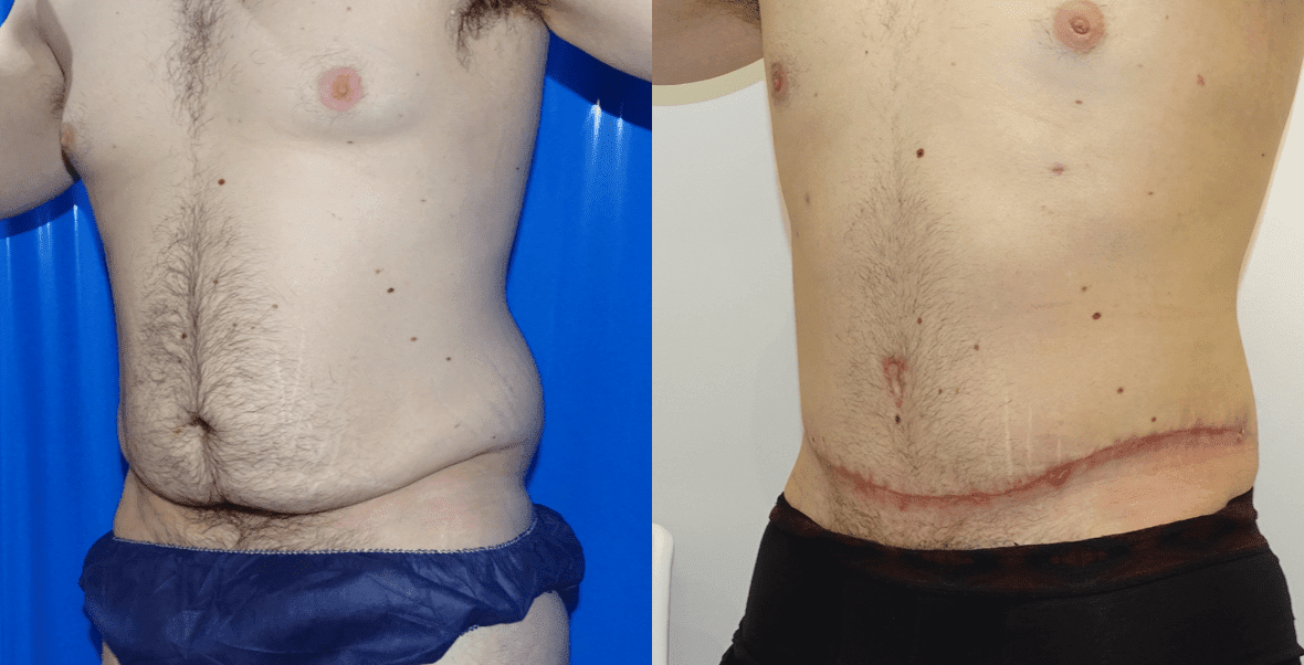 Tummy Tuck For Loose Skin