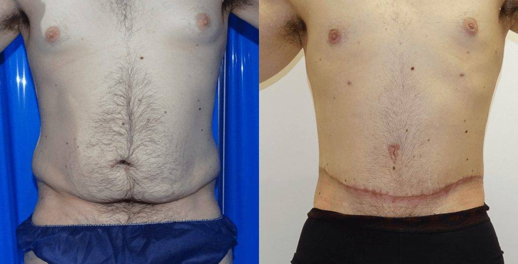A front view of male abdominoplasty with some visible scarring.