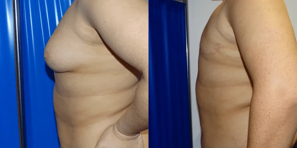 Gynecomastia Surgery London