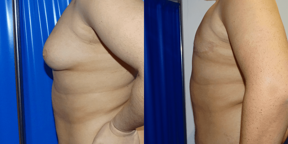Gynecomastia Before/ After - Left Side