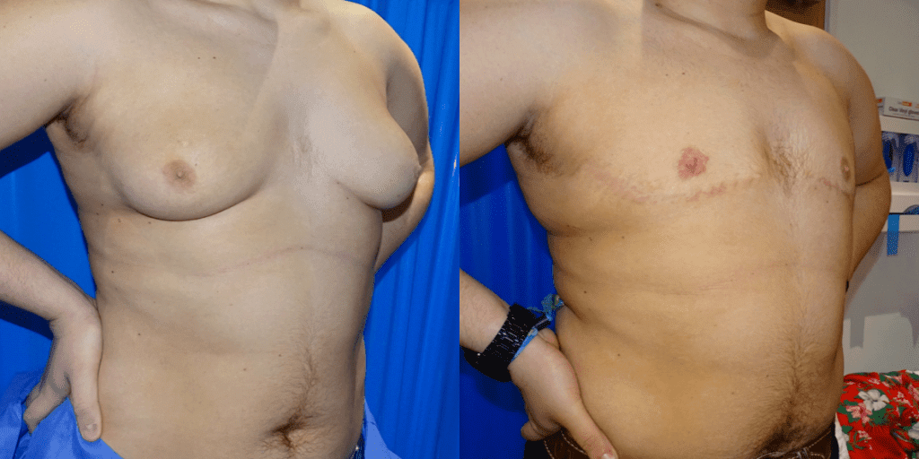 Gynecomastia Before/ After - Front View