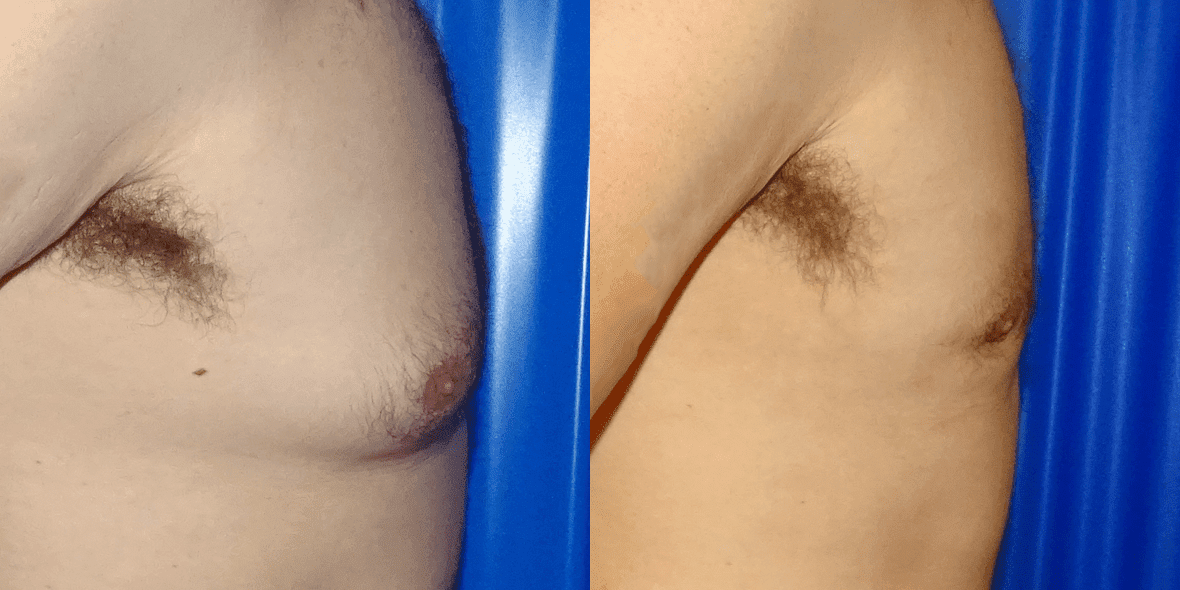 Gynecomastia Before/ After - Right Side Close-Up