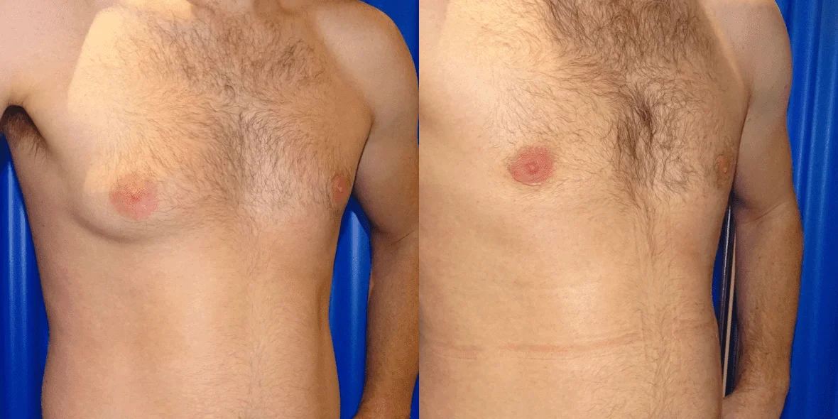 Gynecomastia Before/ After - Front View Close-Up
