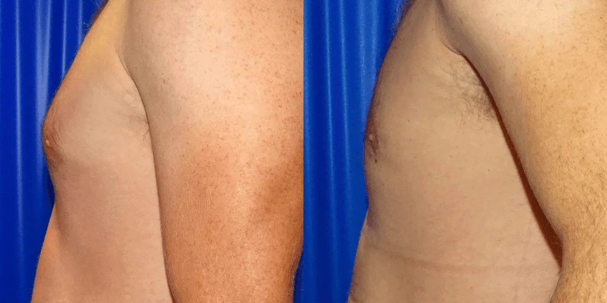Gynecomastia Before/ After - Left Side Close-Up