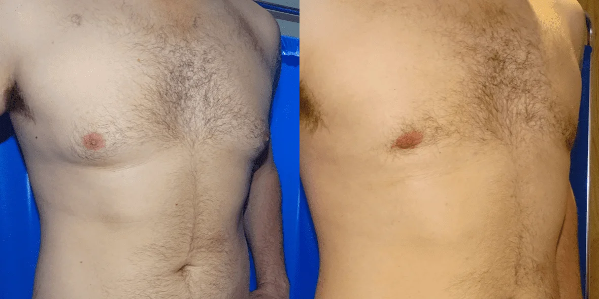 Gynecomastia Before/ After - Front View Close-Up