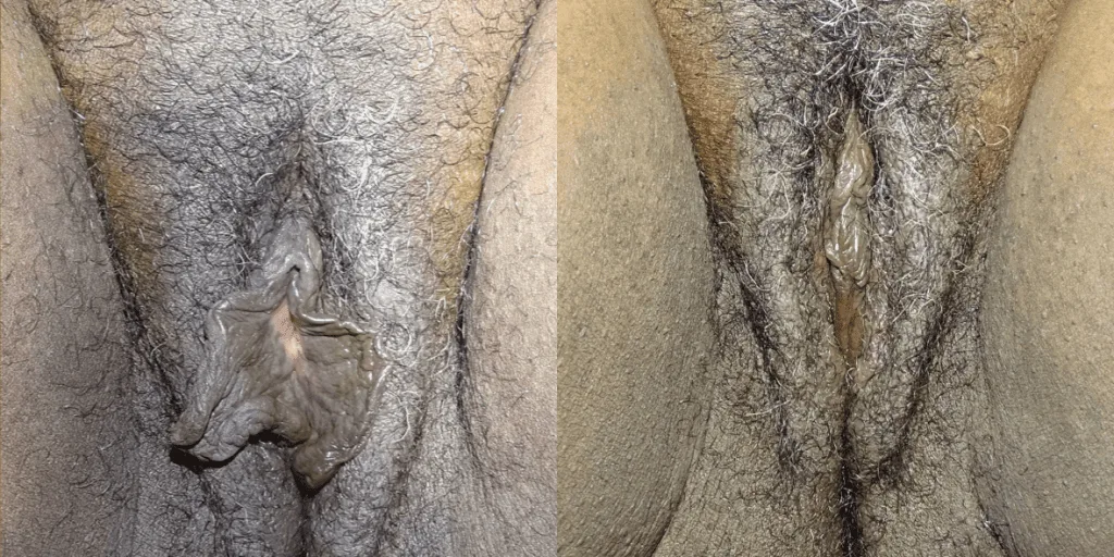 Labiaplasty London, Uk
