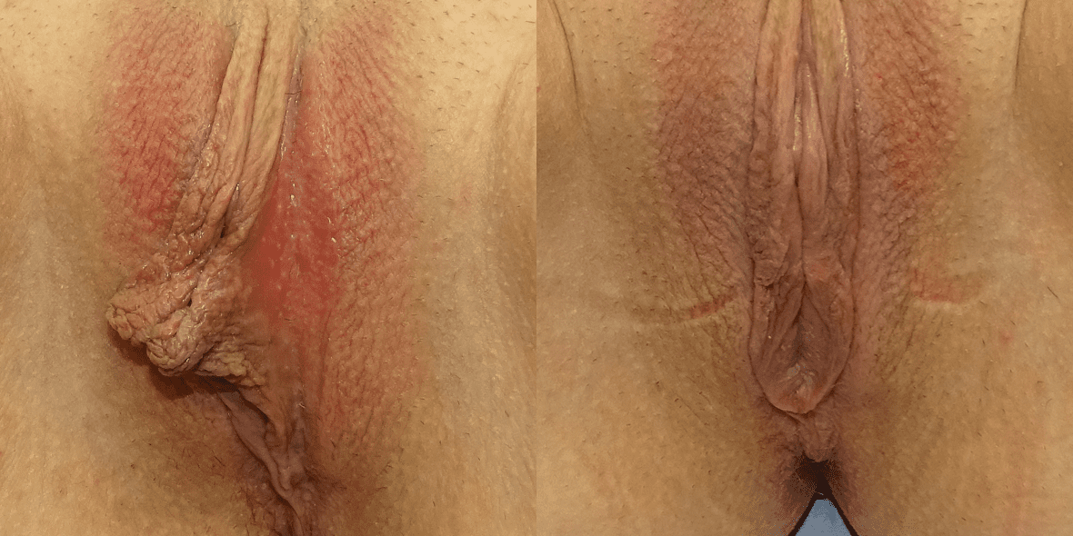 Labiaplasty Before And After