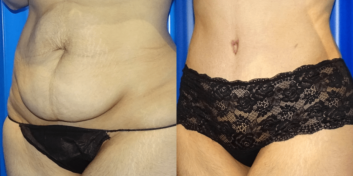 Lipoabdominoplasty Before/ After - Front View