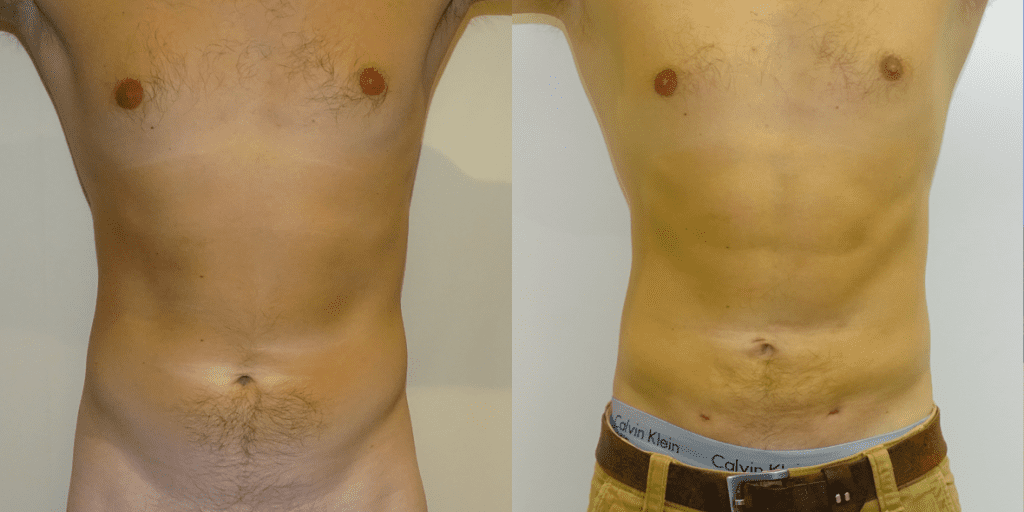 before and after male liposuction