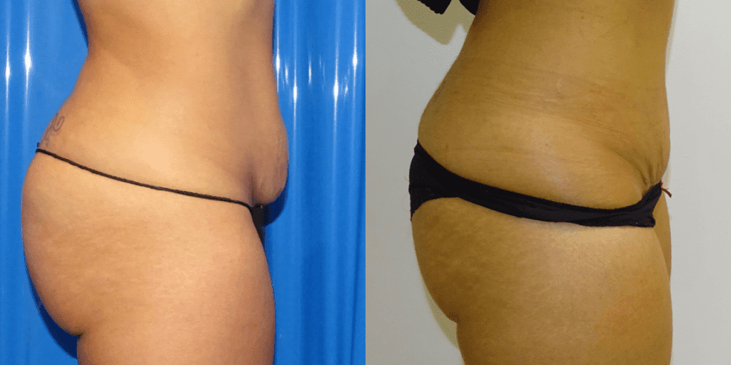 A side view of a minimal abdominoplasty.