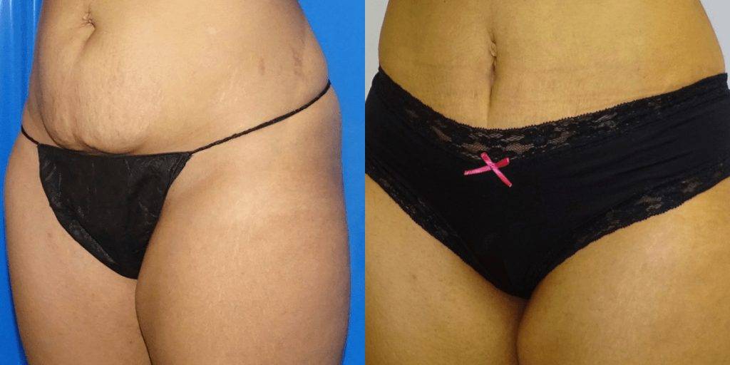 A close up view of a woman's lower stomach after abdominoplasty.