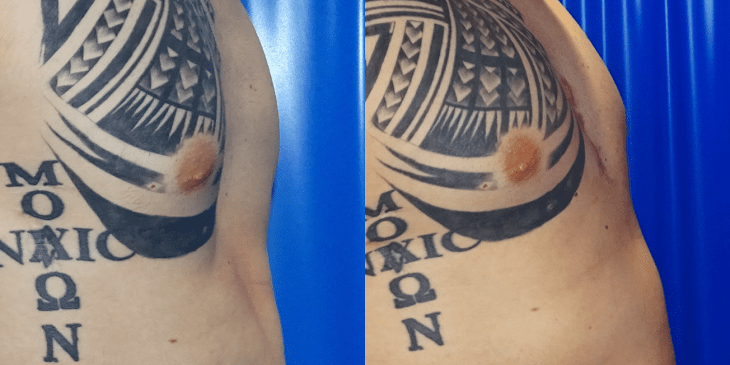 Side-By-Side Images Of A Man's Pectoral Region Showing Before And After Receiving Pectoral Implants