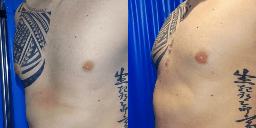 Side-By-Side Images Of A Man's Pectoral Region Showing Before And After Receiving Pectoral Implants