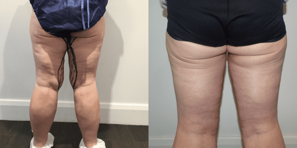 Thigh Lift Before/ After - Back
