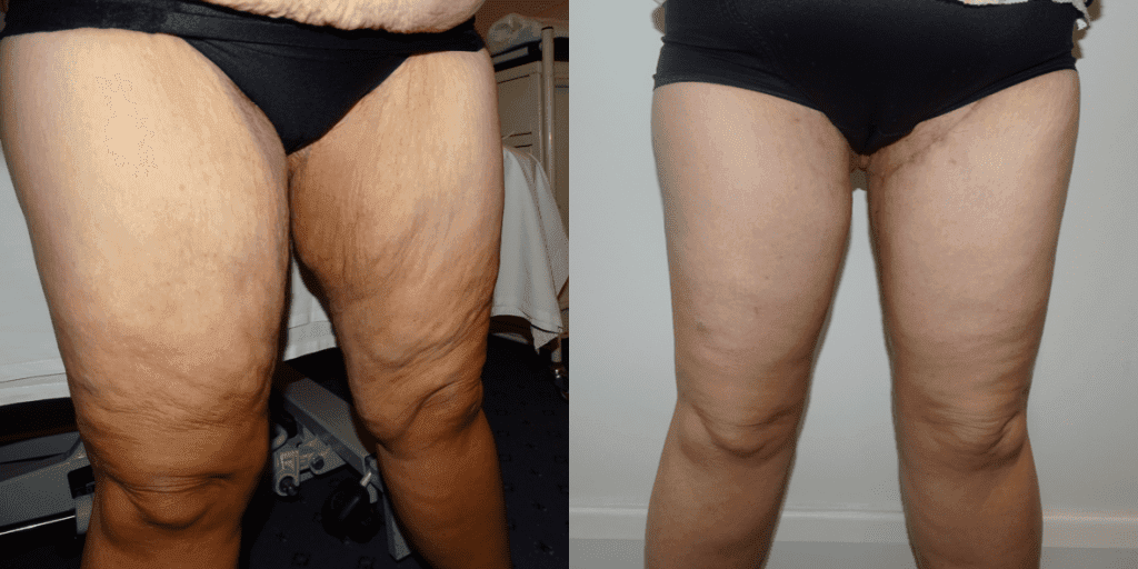 Before and after thigh lift reduction surgery images of a person's legs.