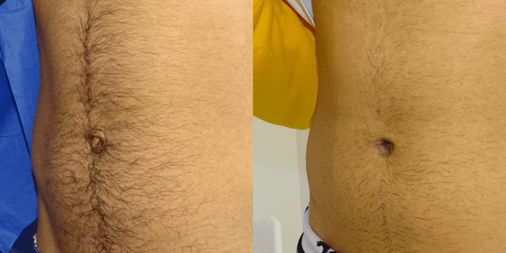 Umbilicoplasty