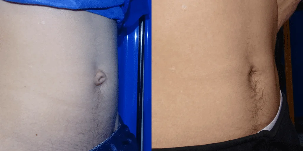 Umbilicoplasty