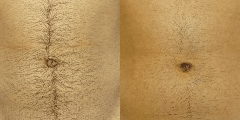 Umbilicoplasty