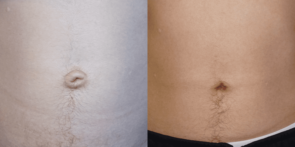 Umbilicoplasty Before/ After