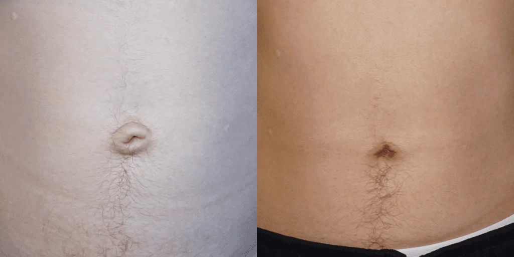 Umbilicoplasty