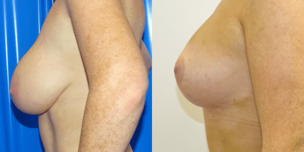 A before and after picture of a breast augmentation.