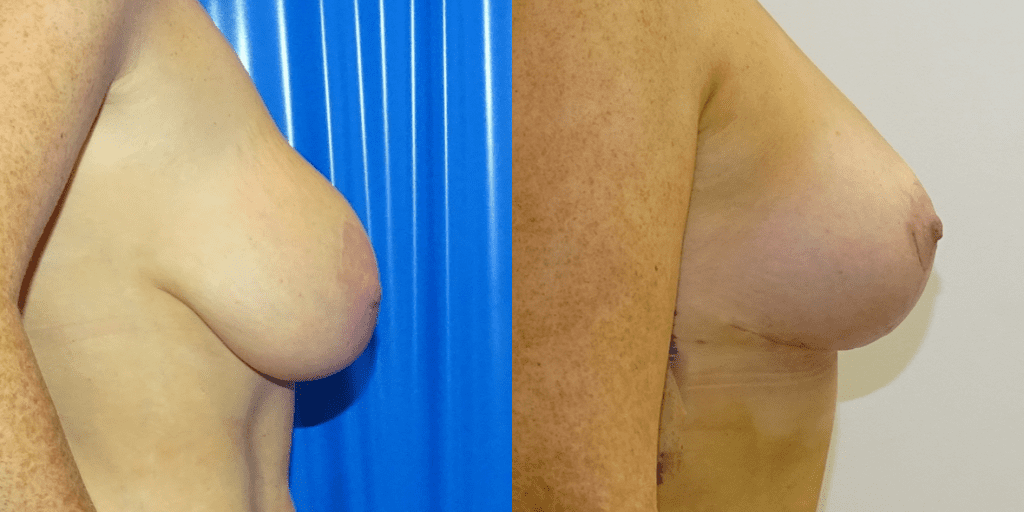 Mastopexy Before/ After - Right Breast