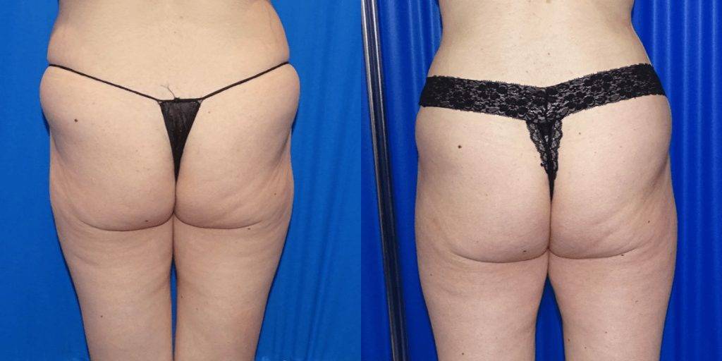 An image of abdominoplasty surgery results from the back.