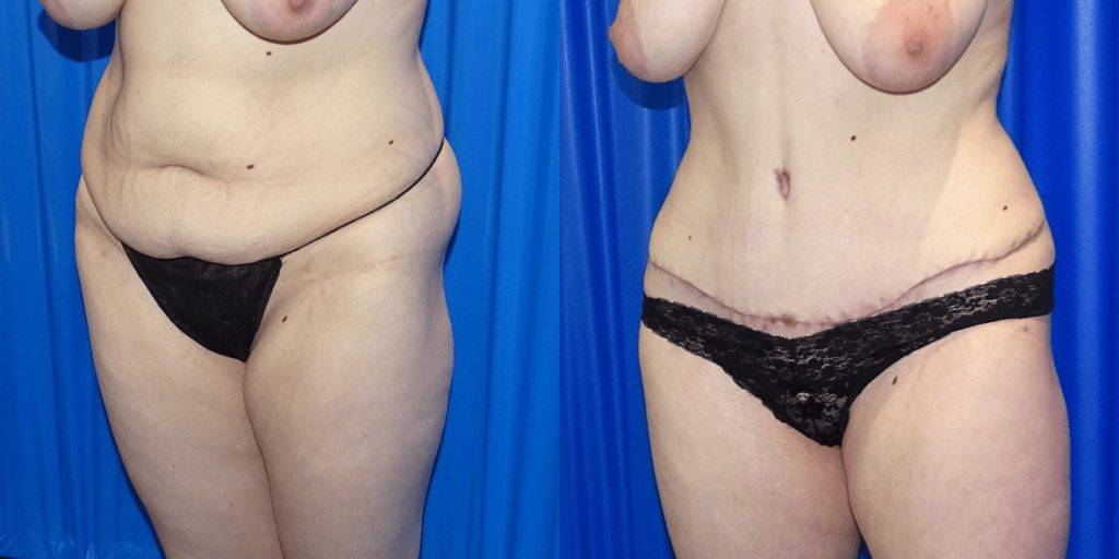 The results of abdominoplasty surgery with some scarring.