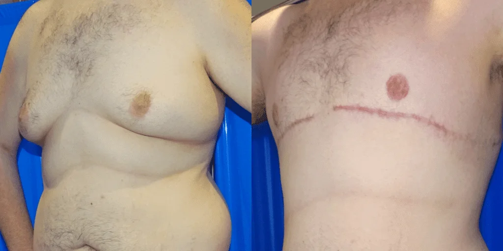 Gynecomastia Surgery London
