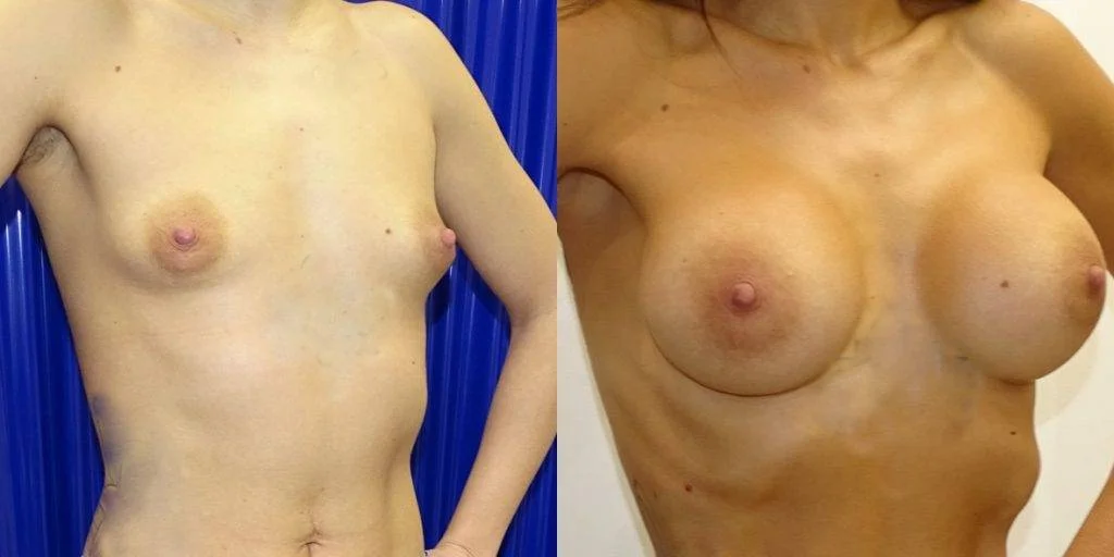 Breast Augmentation