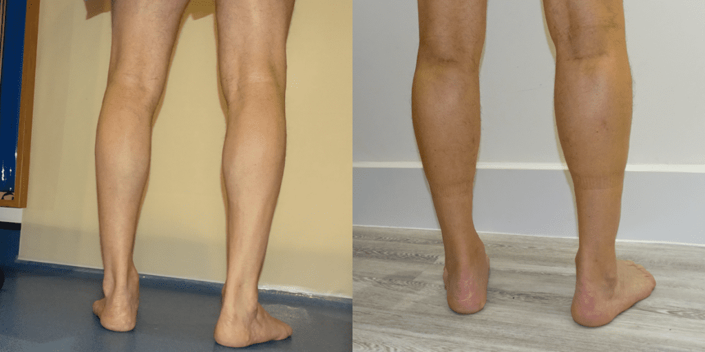 A calf augmetation with minimal scarring and brusing.