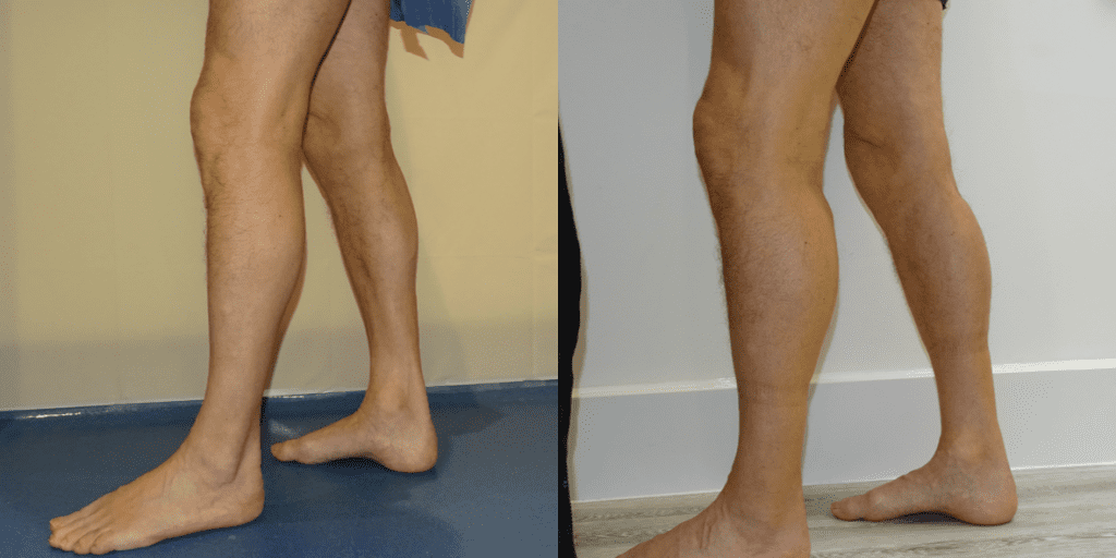 A healed calf augmentation viewed from the side.