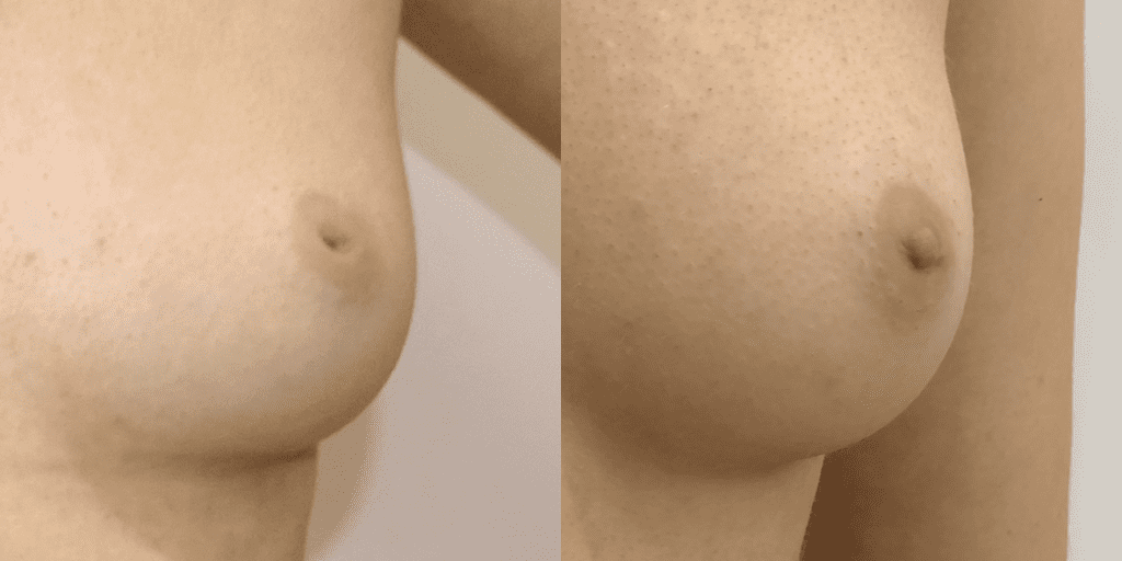 A before and after of an inverted nipple.