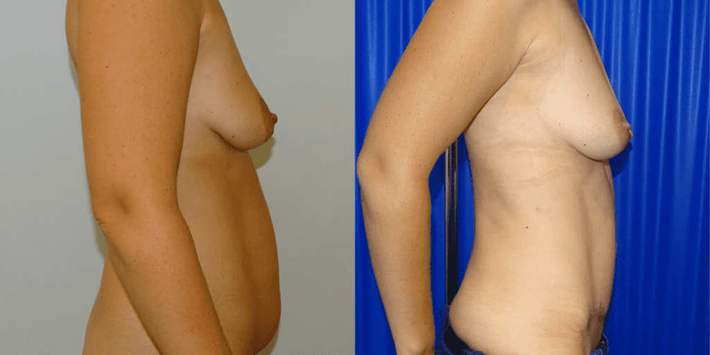 A before and after of a woman's stomach after Mommy Makeover Surgery.