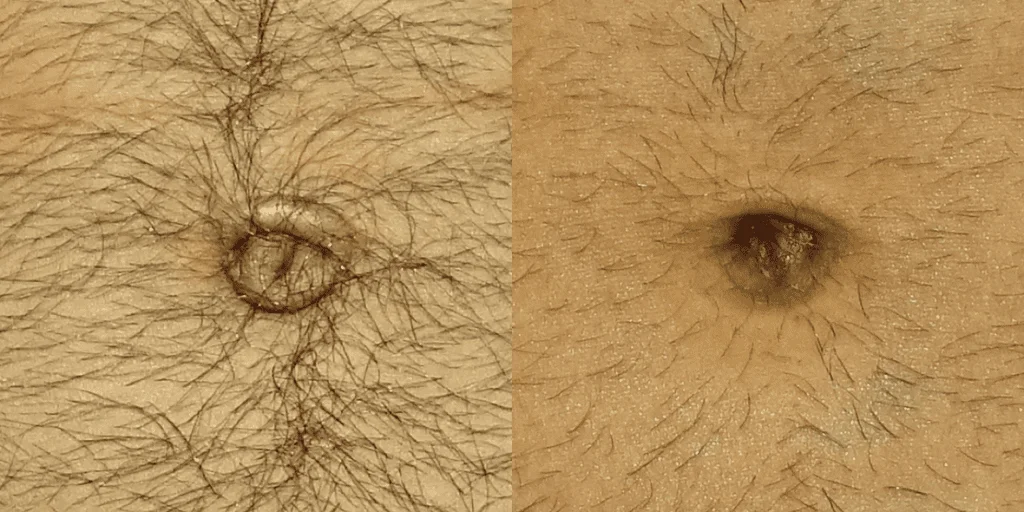 Umbilicoplasty