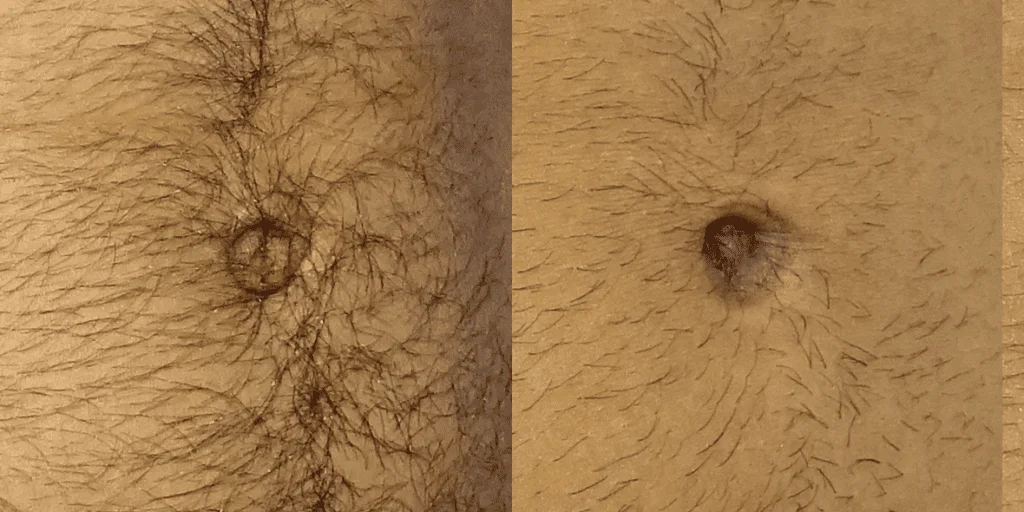 Umbilicoplasty