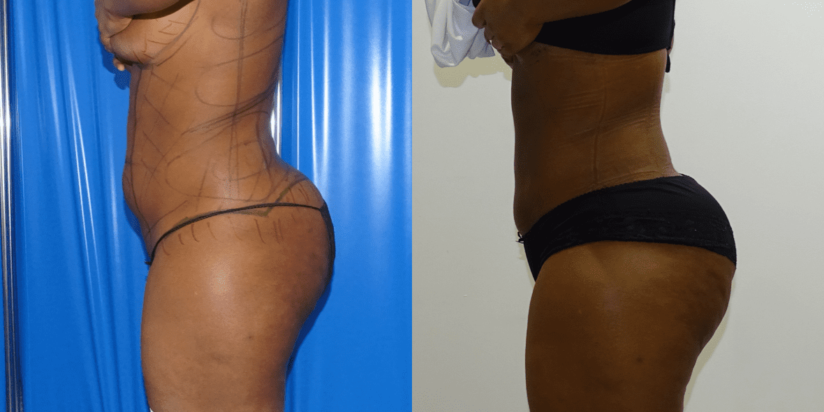 Liposuction Before/ After - Left Side
