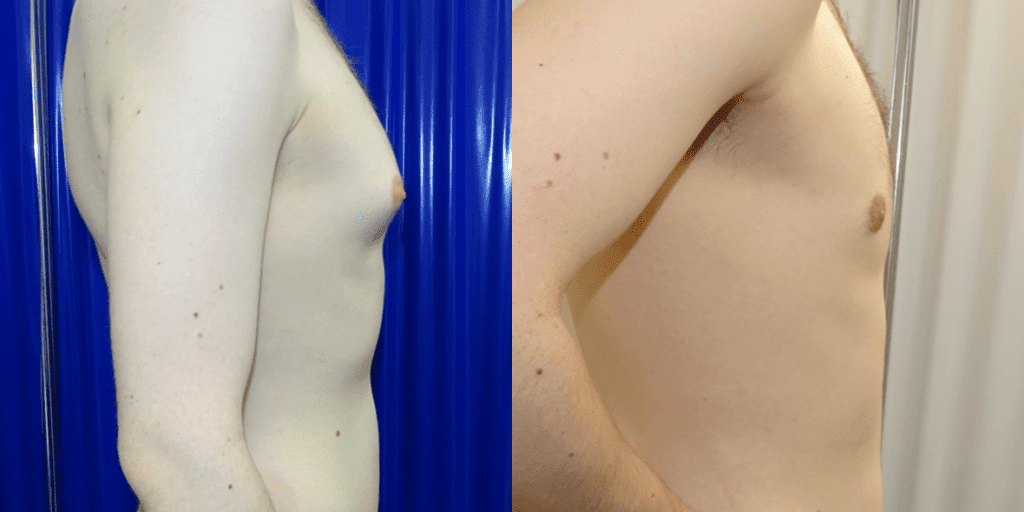 Gynecomastia Before/ After - Right Side